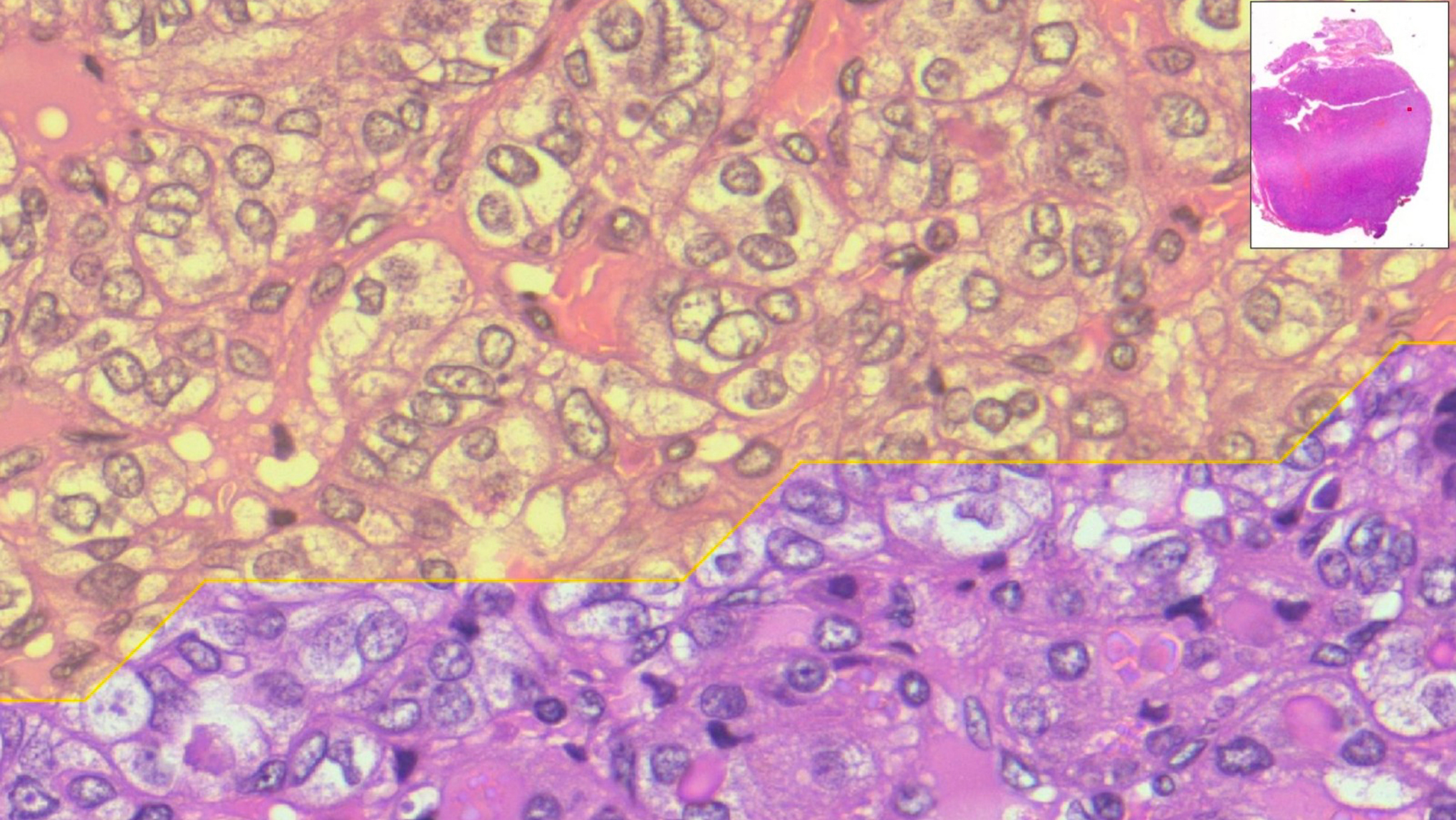 Dalla ricerca ANTHEM nasce MiThyCA, un sistema di Intelligenza Artificiale che aiuta i medici nella lettura delle immagini digitali per una diagnosi più rapida ed efficace dei tumori.